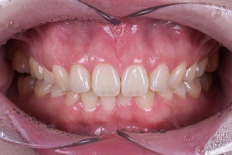 미니쉬 화이트 - case 01 - 미니쉬 적용 전