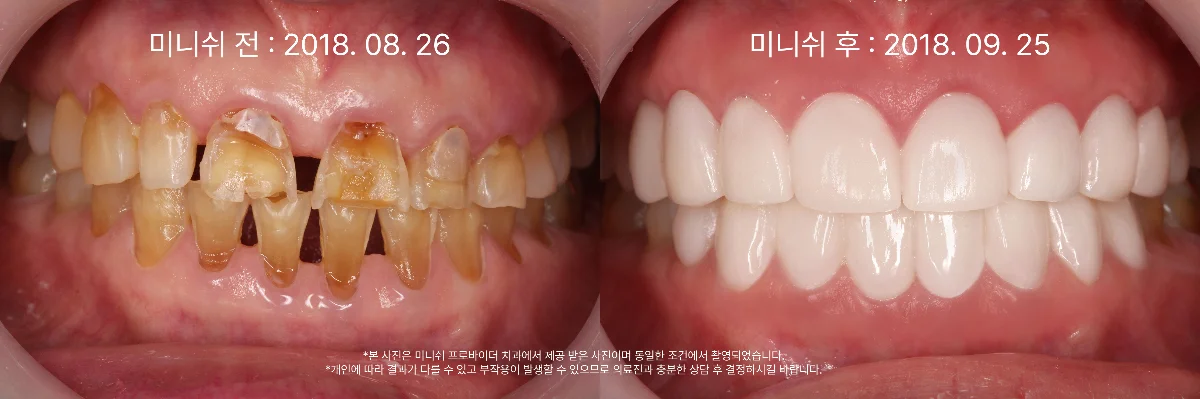 미니쉬전후_리버스에이징